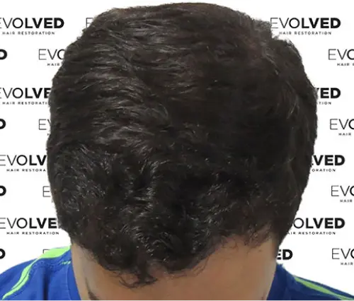 Male Patient Look After Hair Transplant