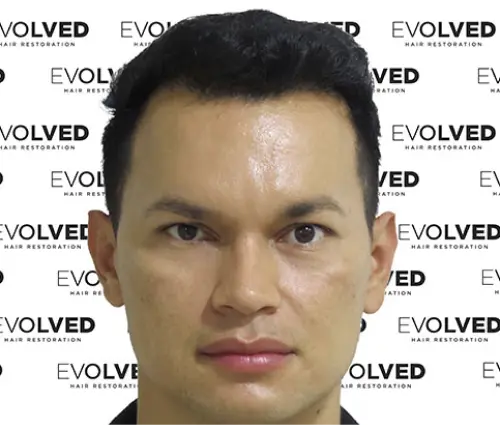 Male Patient Look After Hair Transplant