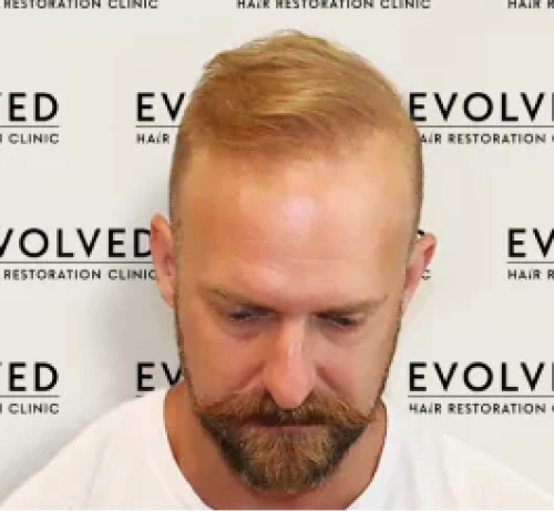 Male Patient Look After Hair Transplant