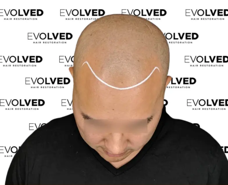 Male Patient Look Before Hair Transplant