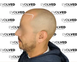 Male Patient Look Before Hair Transplant