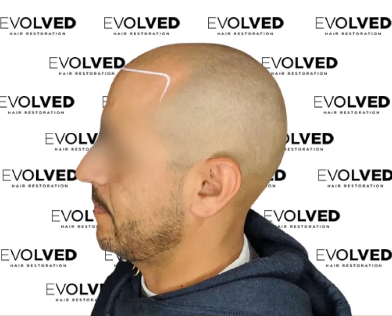 Male Patient Look Before Hair Transplant