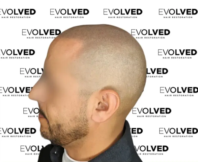 Male Patient Look Before Hair Transplant