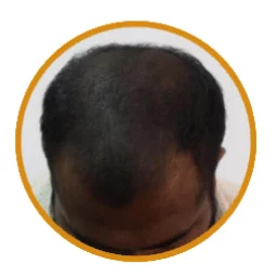 Male Patient Look Before Hair Transplant
