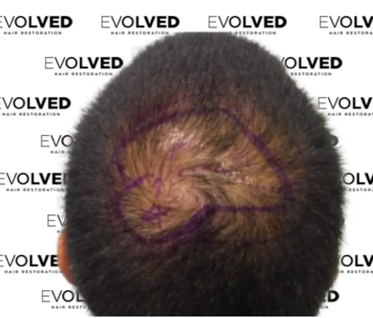 Male Patient Look Before Hair Transplant