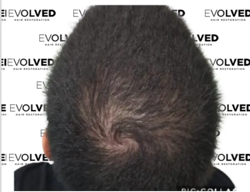 Male Patient Look Before Hair Transplant