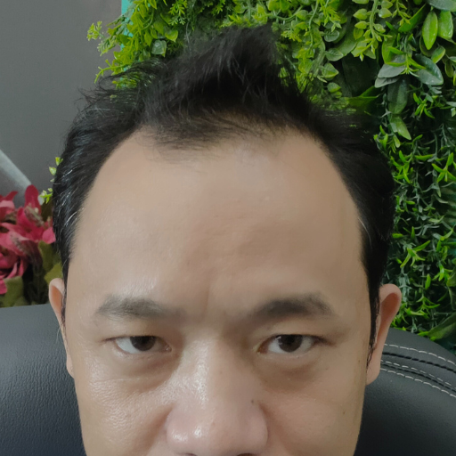 Male Patient Look Before Hair Transplant
