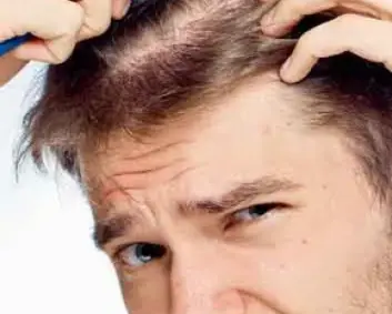 signs of hair loss